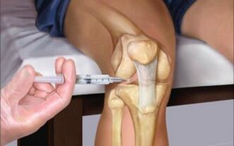 inyección intraarticular en la articulación para la osteoartritis