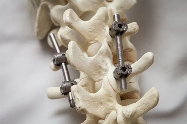 fijación de la columna vertebral osteocondrosis del cuello