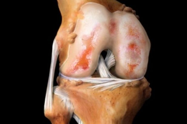 Daño del cartílago en la osteoartritis de rodilla. 
