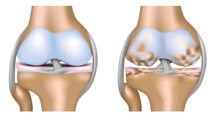 cartílago sano y daño a la articulación de la rodilla con osteoartritis