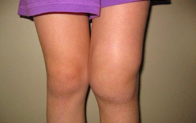 rodilla hinchada por artrosis