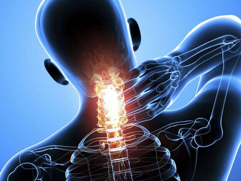 La osteocondrosis de la columna cervical se acompaña de dolor en el cuello. 