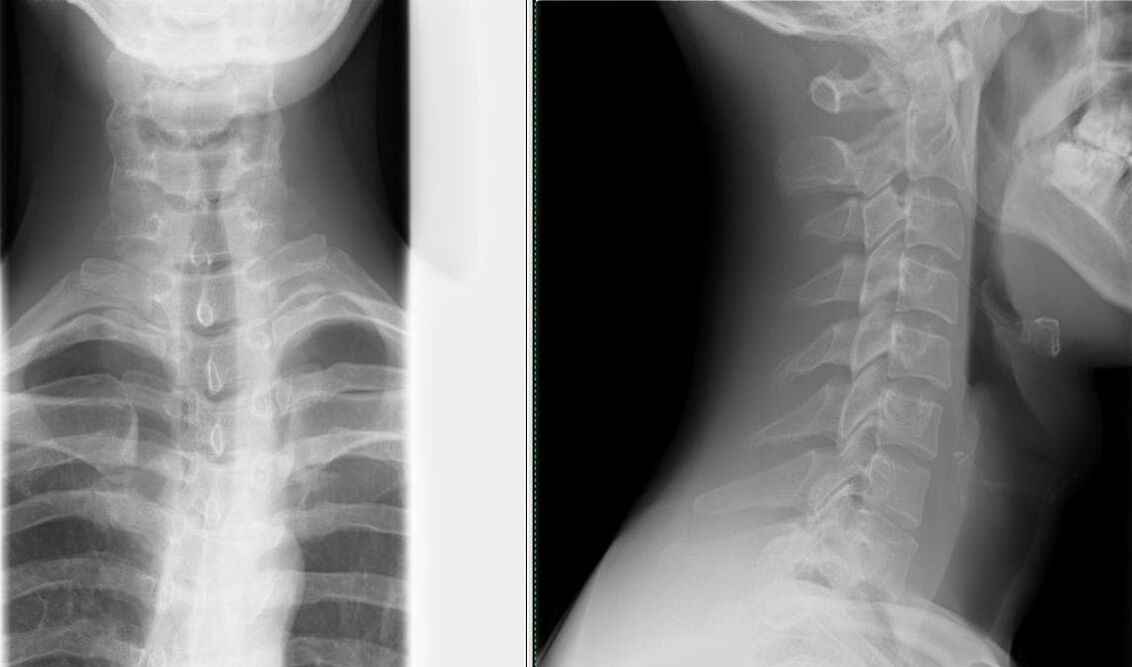 La radiografía de columna es un método simple y eficaz para diagnosticar la osteocondrosis. 