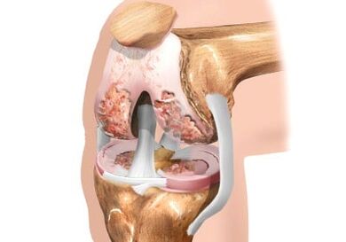 Daño a la artrosis de la articulación de la rodilla