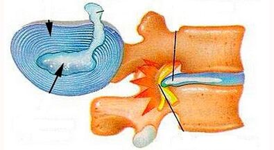 Características del desarrollo de la osteocondosis cervical