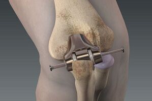 reemplazo de rodilla para la osteoartritis
