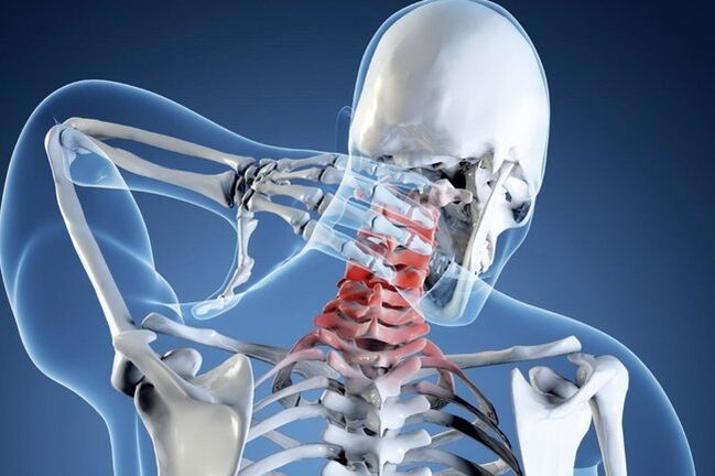osteocondrosis de la columna cervical
